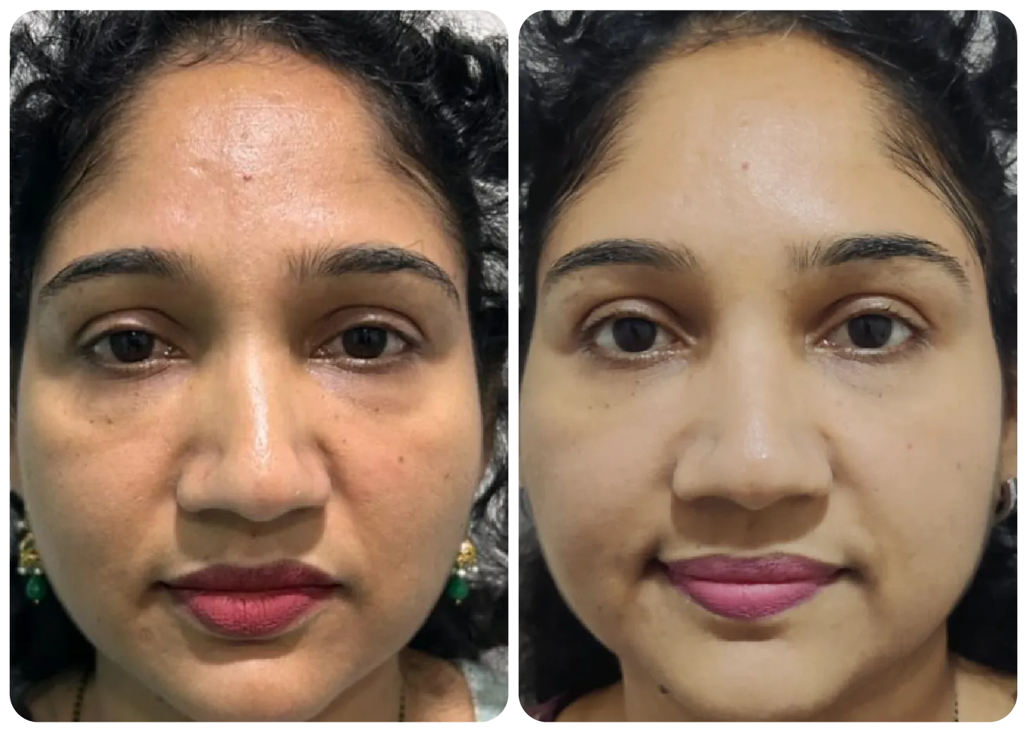 dull-skin-treatment-before-after-4