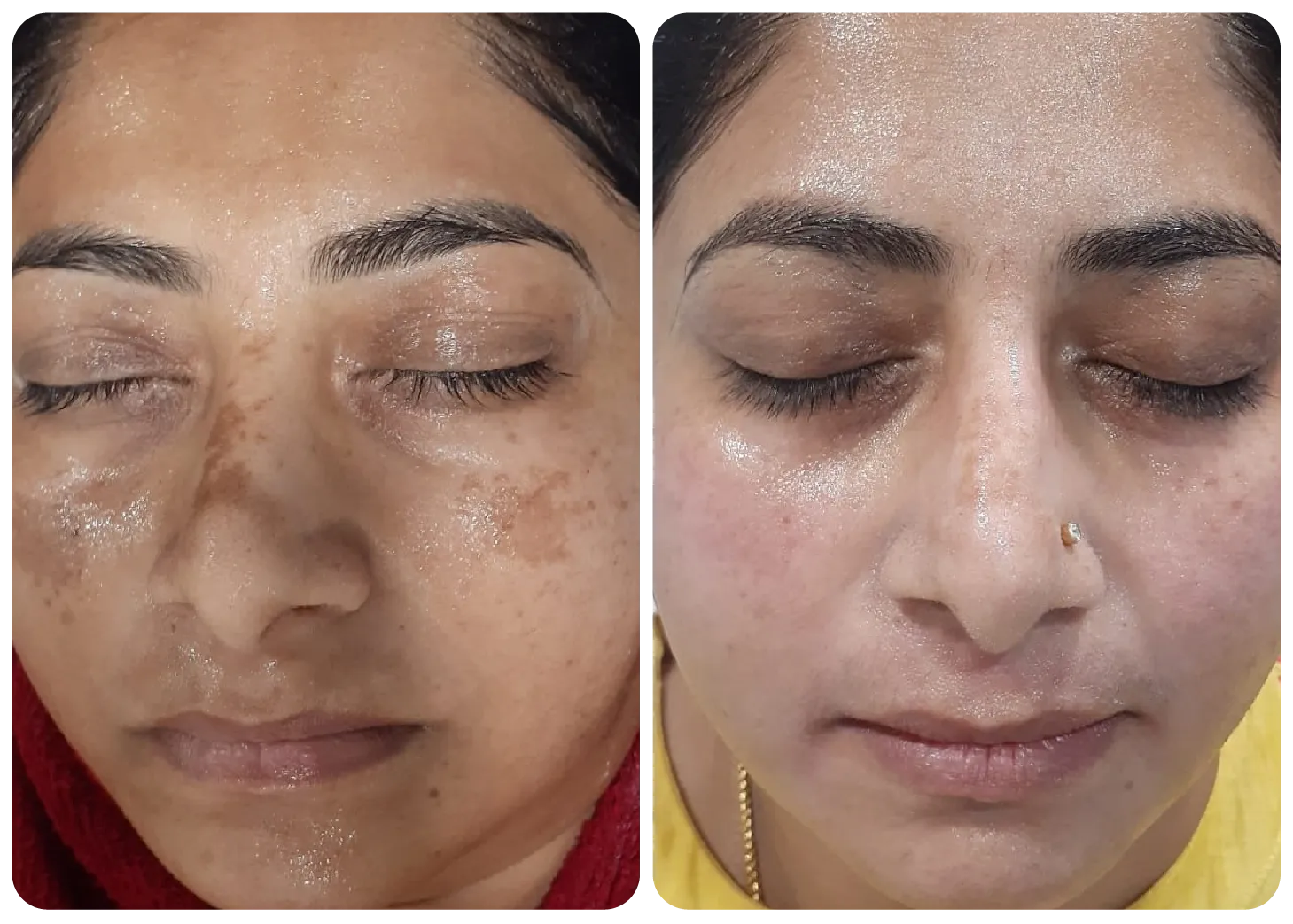 pigmentation-treatments-before-after-3
