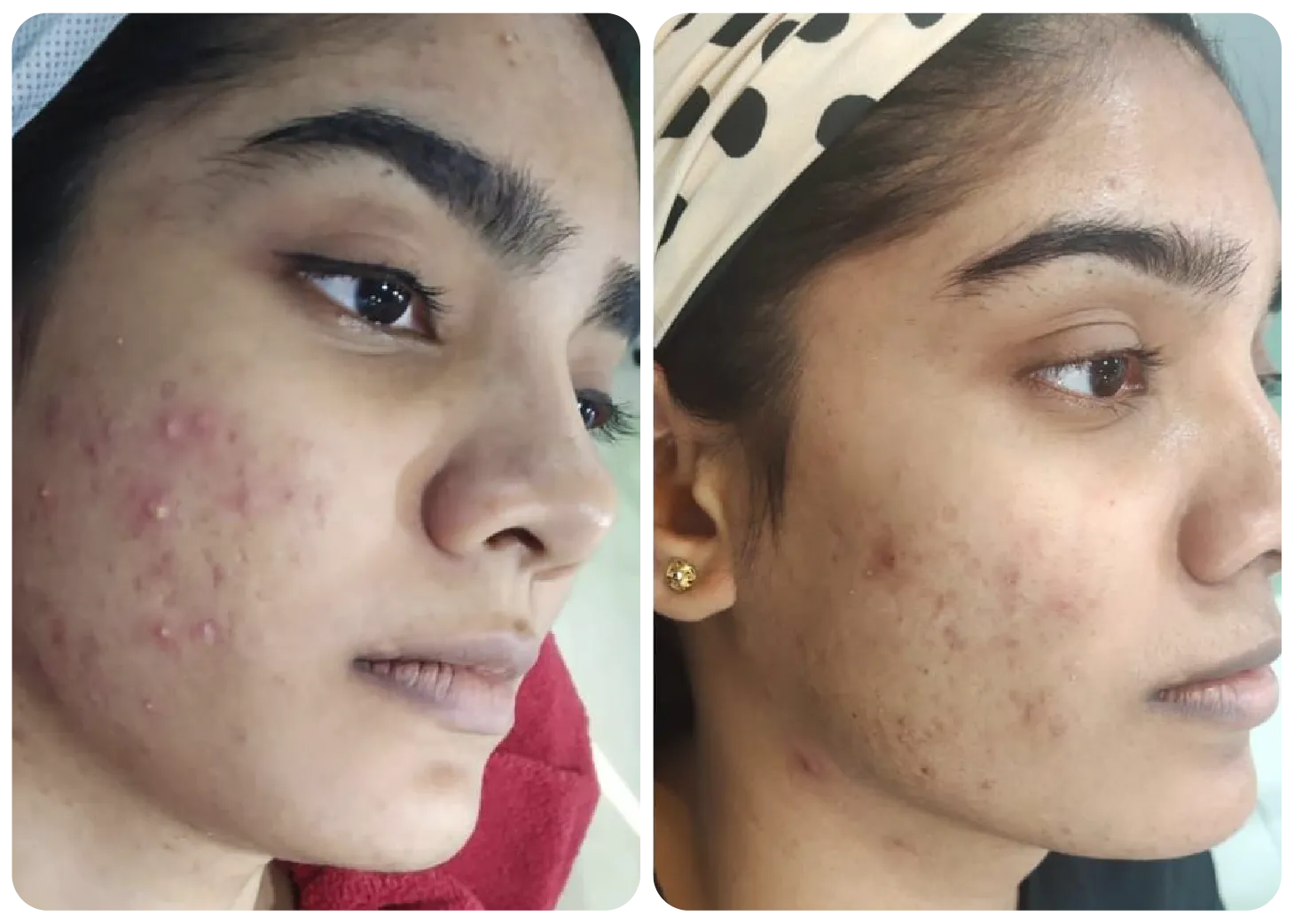 pimple-treatment-before-after-7