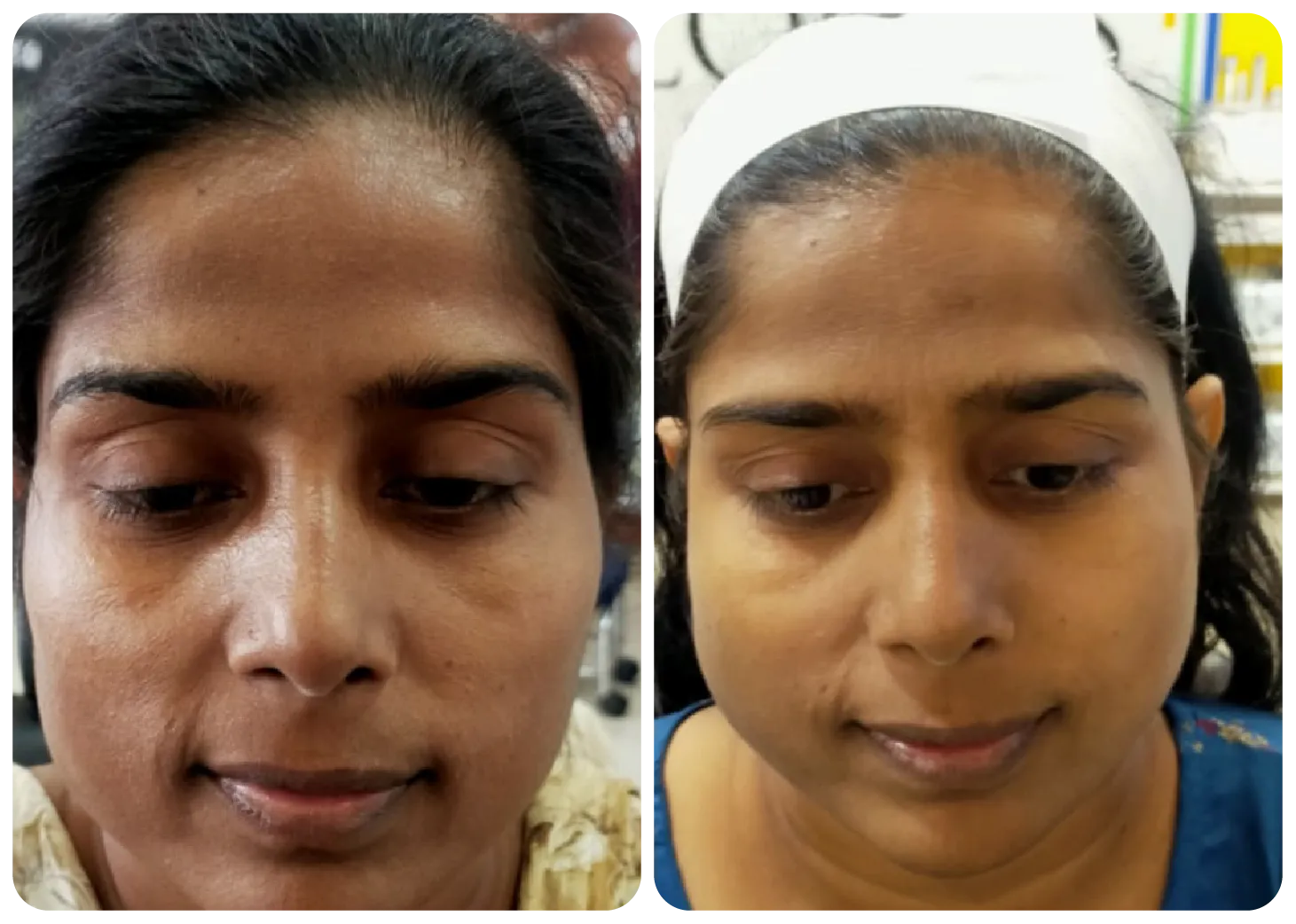 skin-polishing-before-after-2